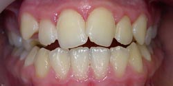 Фото до лечения - тесное положение зубов спереди