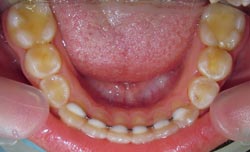 Фото после лечения - нижние зубы