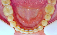Завершение ортодонтического лечения